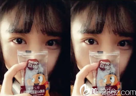 暑假找呼和浩特華美做韓式無痕7mm雙眼皮七天全消腫了