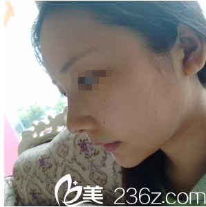 重慶賽格爾馬強隆鼻7天拆線