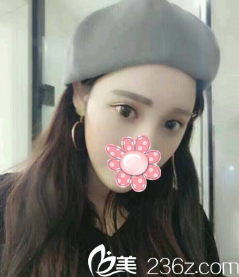 術(shù)后11天，看不到眼袋了