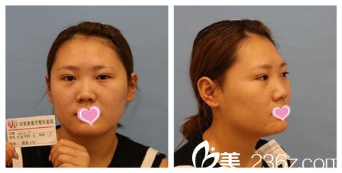 做隆鼻手術(shù)前鼻子塌平 做隆鼻手術(shù)前鼻子塌平