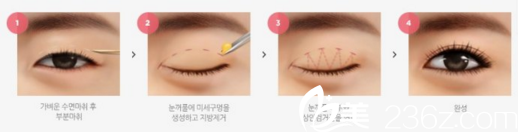 張院長研發(fā)的自然粘連法雙眼皮術(shù) 張院長研發(fā)的自然粘連法雙眼皮術(shù)