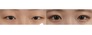 眼部手術(shù)案例之眼媚矯正 眼部手術(shù)案例之眼媚矯正