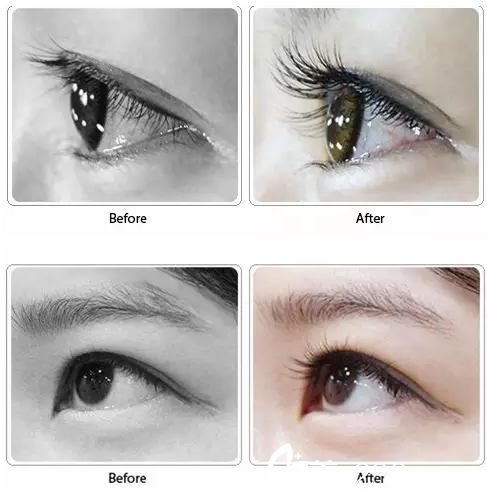 太原善美整形真人案例 太原善美整形真人案例