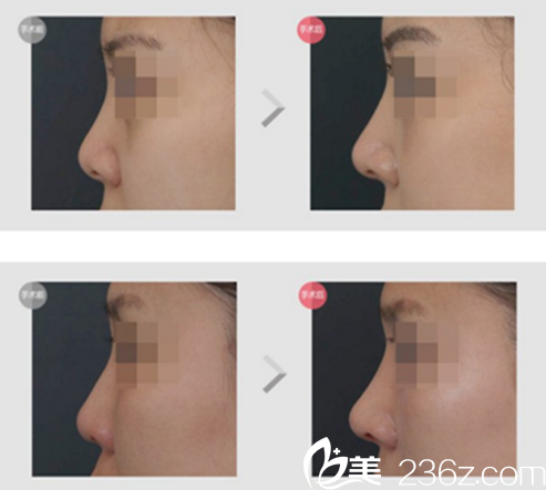 車(chē)明奎院長(zhǎng)鼻修復(fù)案例 車(chē)明奎院長(zhǎng)鼻修復(fù)案例