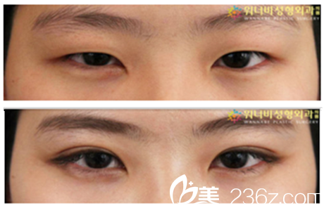 柳錫泰院長(zhǎng)雙眼皮真人案例對(duì)比 柳錫泰院長(zhǎng)雙眼皮真人案例對(duì)比