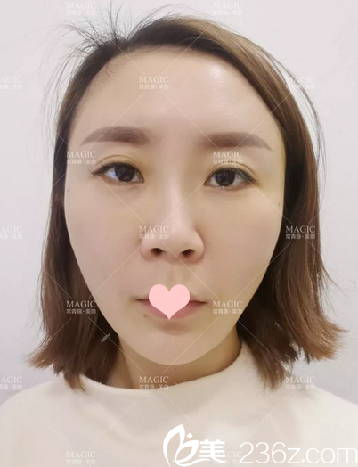 全臉做完線雕提升的即刻效果