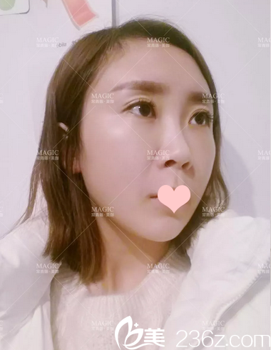 面部線雕提升術后5天恢復情況