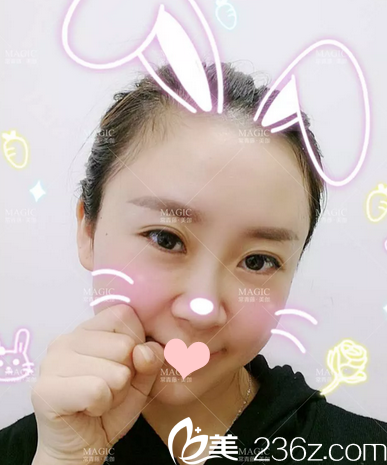 做完線雕的我長這樣