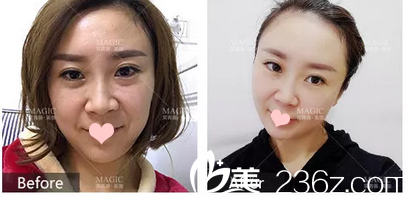 線雕提升前后對比圖