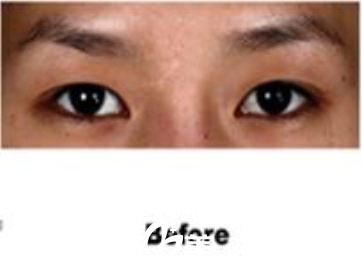 單眼皮內雙怎么變雙眼皮 單眼皮內雙怎么變雙眼皮