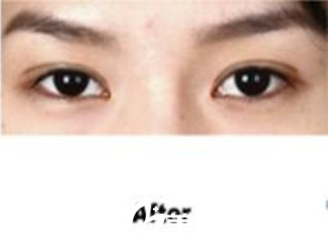 雙眼皮手術后3個月 雙眼皮手術后3個月