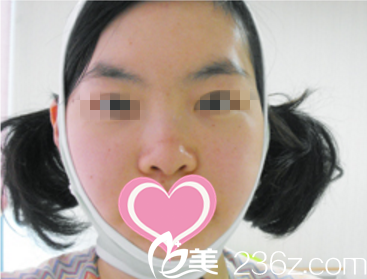 奧納比整形術(shù)后第三天真人案例 奧納比整形術(shù)后第三天真人案例