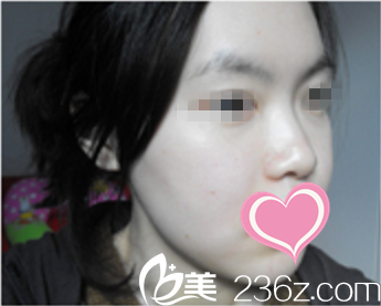 做完雙顎手術(shù)后一周 做完雙顎手術(shù)后一周