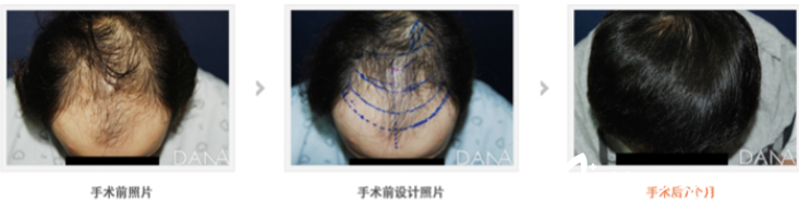 柳升賢院長毛發(fā)移植術(shù)后效果