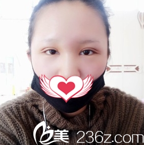 太原善美整形雙眼皮案例7天拆線