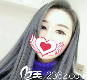 雙眼皮案例術(shù)后2個月效果太原善美整形