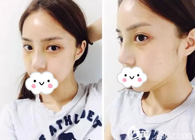 術(shù)后七天雙眼皮和隆鼻恢復(fù)過程 術(shù)后七天雙眼皮和隆鼻恢復(fù)過程