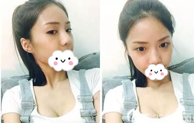 雙眼皮+隆鼻術(shù)前樣子 雙眼皮+隆鼻術(shù)前樣子