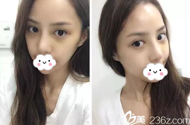 眼鼻整形術(shù)后15天恢復(fù) 眼鼻整形術(shù)后15天恢復(fù)