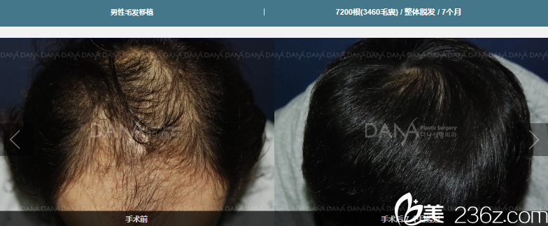 7200根毛發(fā)移植效果 7200根毛發(fā)移植效果