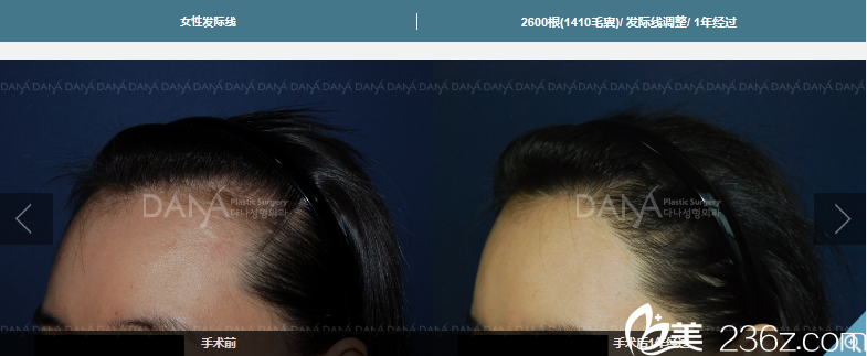 金娜萊院長女性發(fā)際線調(diào)整效果 金娜萊院長女性發(fā)際線調(diào)整效果