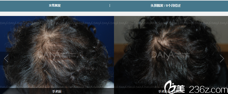 女性脫發(fā)移植 女性脫發(fā)移植