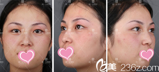 西安高一生切開雙眼皮術(shù)前照 西安高一生切開雙眼皮術(shù)前照