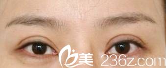 雙眼皮術(shù)后15天恢復(fù)情況 雙眼皮術(shù)后15天恢復(fù)情況