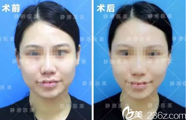 方躍明院長(zhǎng)注射瘦臉案例