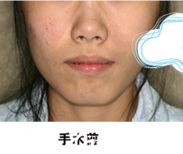 面部輪廓手術(shù)前 面部輪廓手術(shù)前