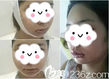 面部輪廓術(shù)后1周 面部輪廓術(shù)后1周