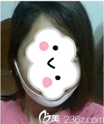 輪廓手術(shù)術(shù)后3周 輪廓手術(shù)術(shù)后3周