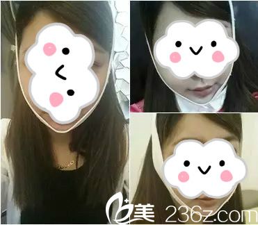 改臉型手術(shù)6周 改臉型手術(shù)6周