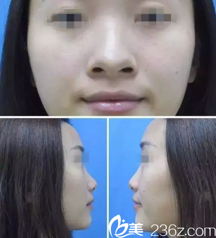 做鼻綜合整形前鼻子塌平 做鼻綜合整形前鼻子塌平