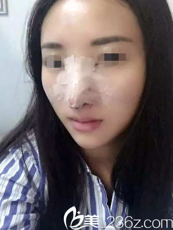 術(shù)后3天鼻子腫脹厲害 術(shù)后3天鼻子腫脹厲害