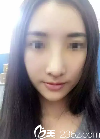 鼻綜合整形后7天鼻子拆線后的樣子 鼻綜合整形后7天鼻子拆線后的樣子