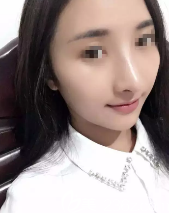 術(shù)后15天鼻子恢復(fù)情況 術(shù)后15天鼻子恢復(fù)情況