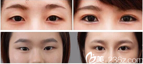 傘光院長(zhǎng)雙眼皮案例 傘光院長(zhǎng)雙眼皮案例