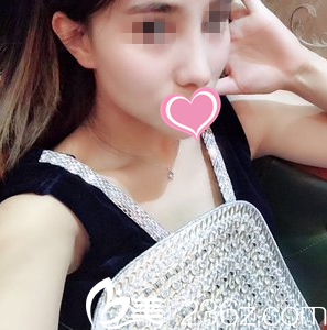 看我找大連達美元辰董世強做鼻綜合術(shù)后一個月恢復(fù)效果