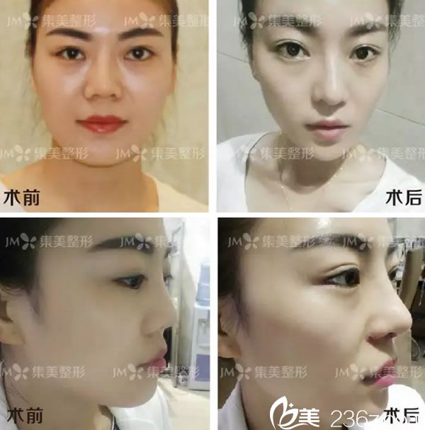 鄭州集美鼻失敗修復1個月恢復照