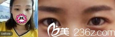 重慶新銅雀臺做全切雙眼皮案例術前 重慶新銅雀臺做全切雙眼皮案例術前