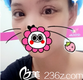 在重慶新銅雀臺做完雙眼皮2天照片 在重慶新銅雀臺做完雙眼皮2天照片