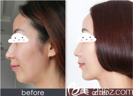 重慶新銅雀臺整形褚健玻尿酸注射豐下巴案例