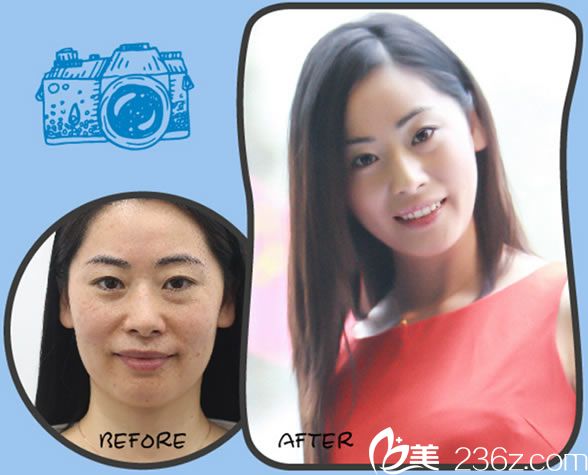 寧波靜港李艷激光祛斑真人案例 寧波靜港李艷激光祛斑真人案例