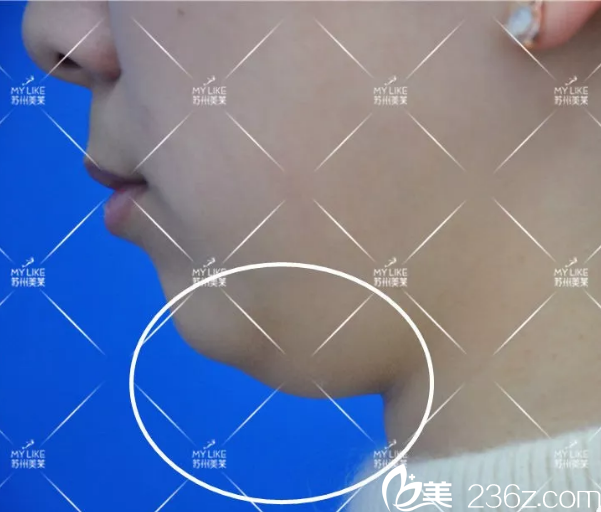 側面看雙下巴更明顯