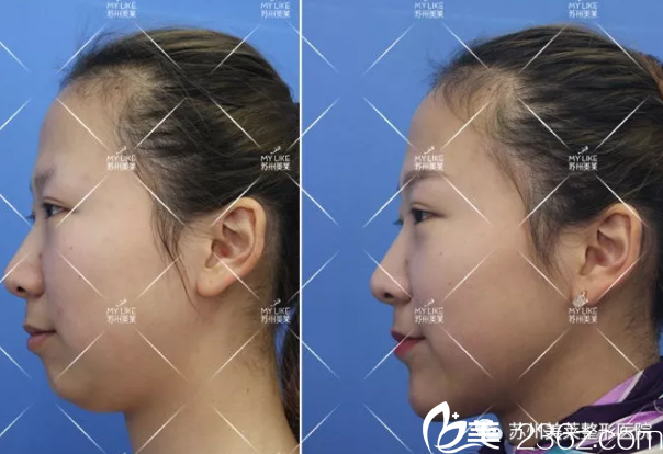 雙下巴整形手術5天效果對比圖