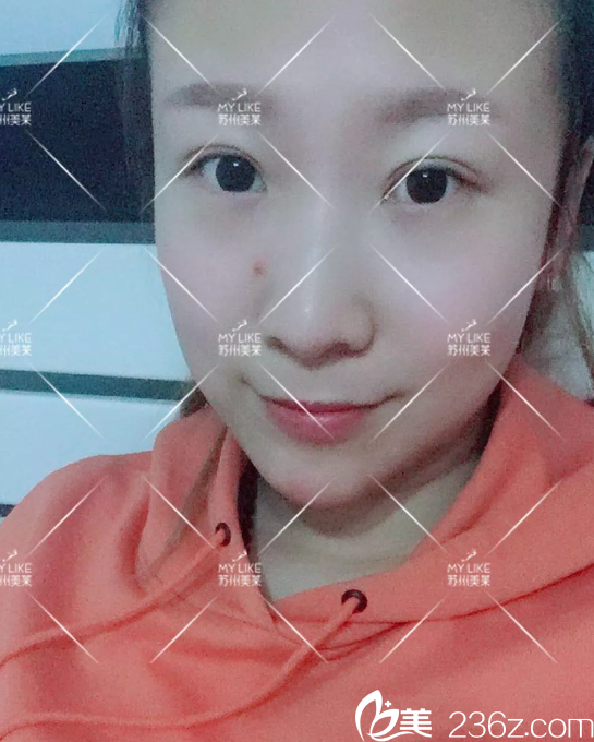 雙下巴整形手術15天恢復照