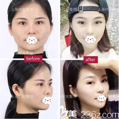 磨骨前后對(duì)比照片 磨骨前后對(duì)比照片