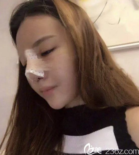 鼻綜合整形手術(shù)第3天恢復(fù)照