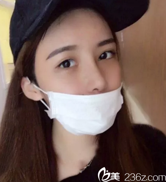 鼻綜合手術(shù)第10天拆完線效果